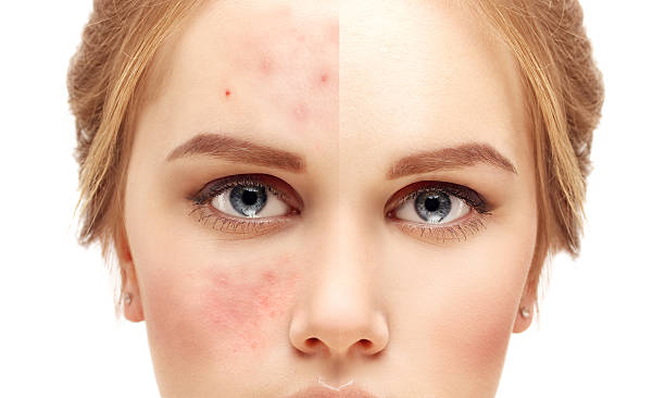 2022's Best Acne Scar Treatment For Acne Scar Removal - Blog - The Island  Now